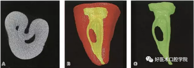 几张图帮你了解C形根管形态、分类及治疗要点总结，慢慢精通RCT!