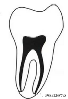 几张图帮你了解C形根管形态、分类及治疗要点总结，慢慢精通RCT!