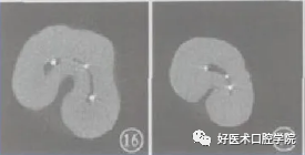 几张图帮你了解C形根管形态、分类及治疗要点总结，慢慢精通RCT!