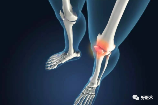 肿痛、弹响、打软腿、运动障碍？高度警惕膝关节软骨的损伤！