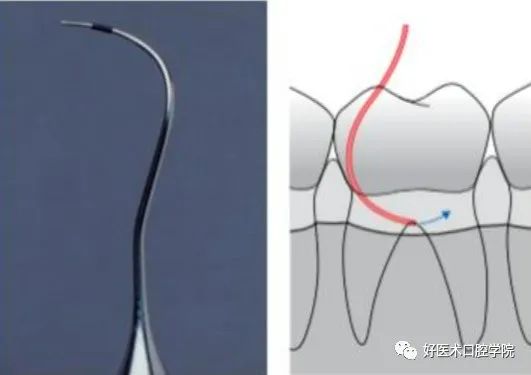 牙周刮治技术，从检查到操作方法，全套要点总结！