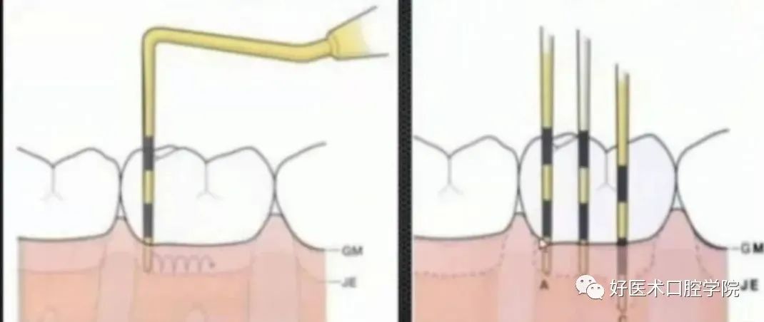 牙周刮治技术，从检查到操作方法，全套要点总结！