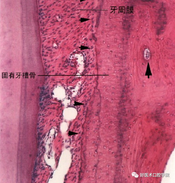 牙槽骨吸收的克星—位点保存术你该了解一下！