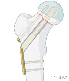 年轻人股骨颈骨折，24小时内达到解剖复位是关键
