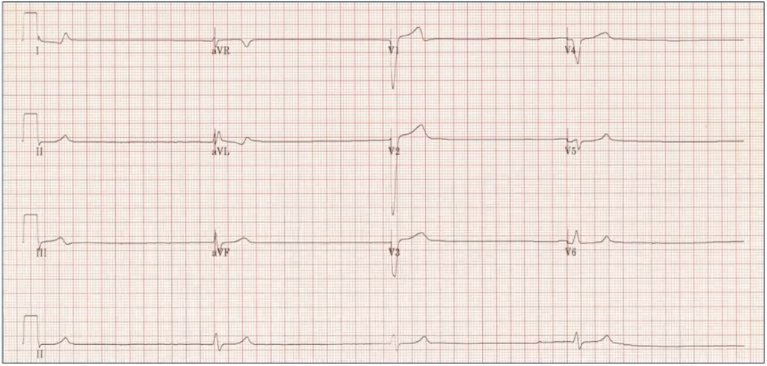 心电图示在一段较正常pp间期显著延长的时间内不见p波,或p波与qrs波均