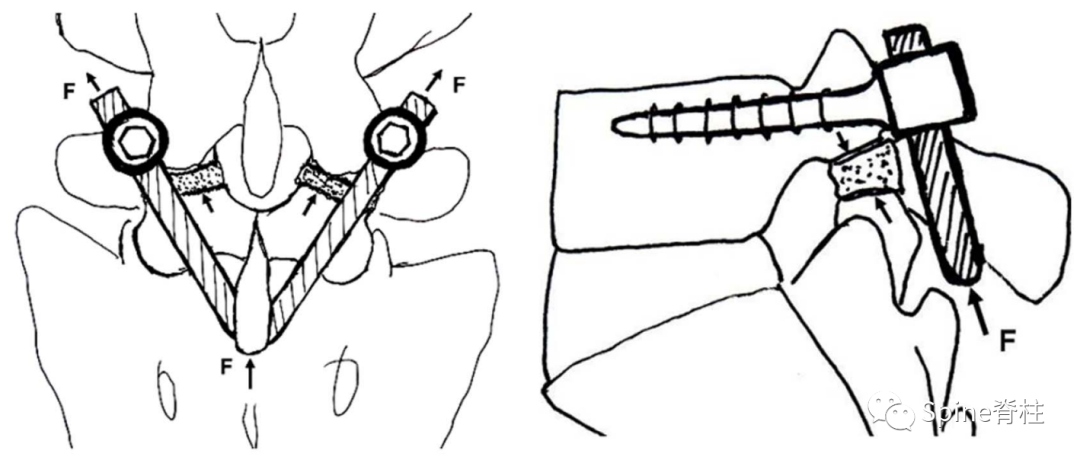腰椎峡部裂修补固定术，这些方案你都会吗？