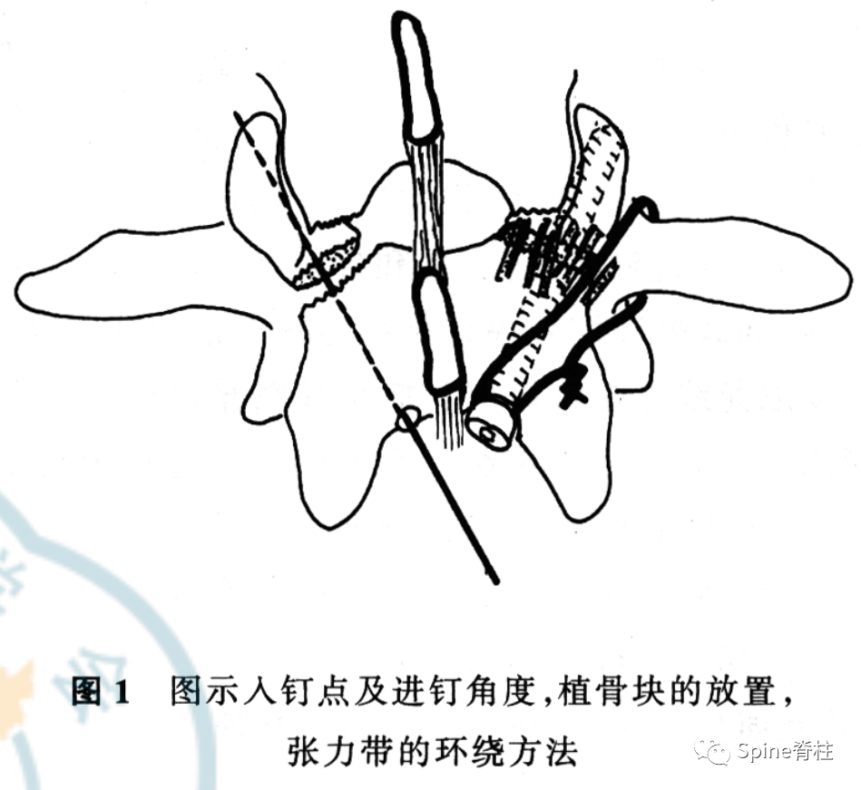 腰椎峡部裂修补固定术，这些方案你都会吗？