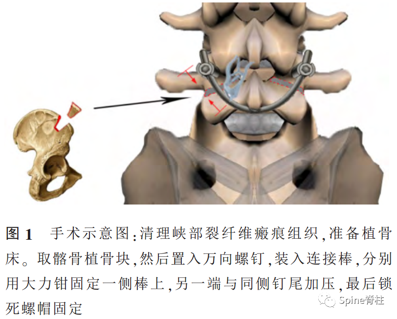 腰椎峡部裂修补固定术，这些方案你都会吗？