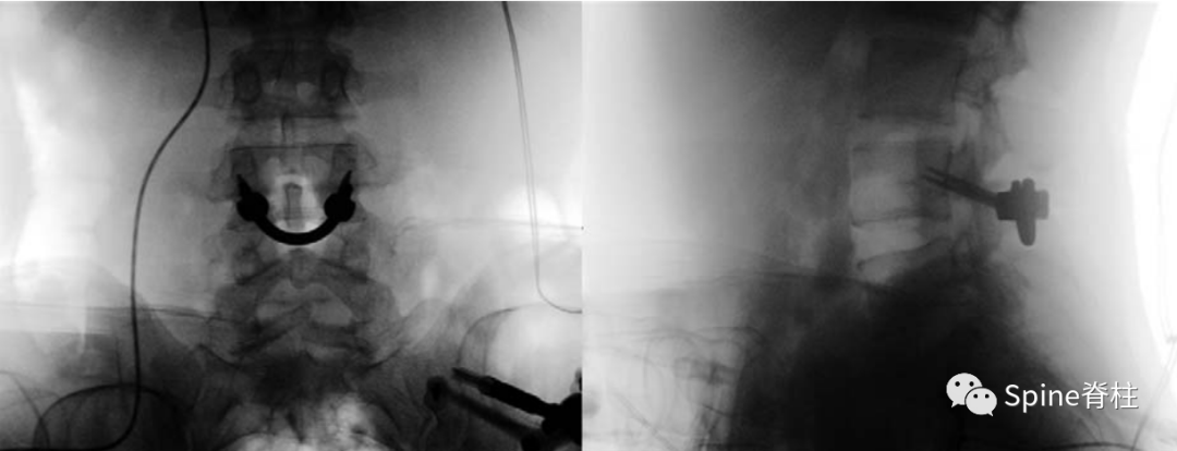 腰椎峡部裂修补固定术，这些方案你都会吗？