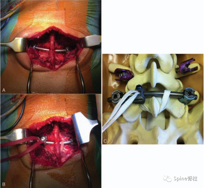 腰椎峡部裂修补固定术，这些方案你都会吗？