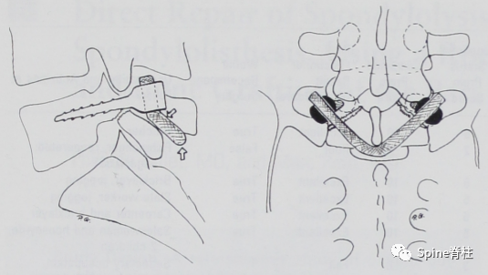 腰椎峡部裂修补固定术，这些方案你都会吗？