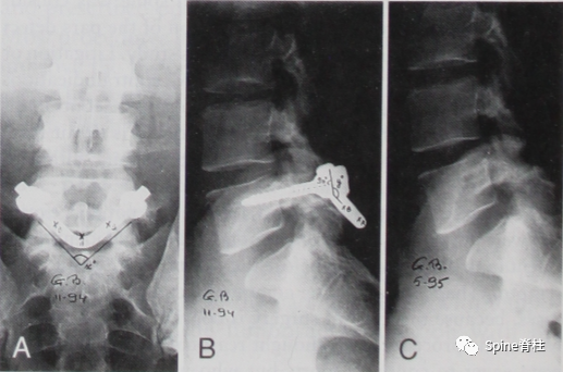 腰椎峡部裂修补固定术，这些方案你都会吗？