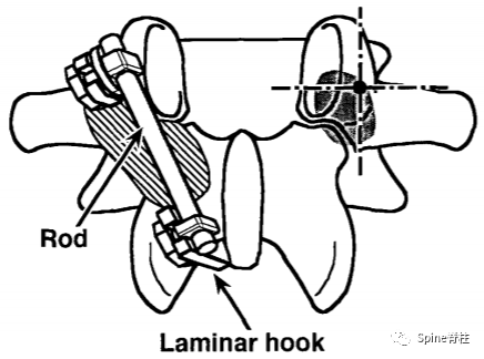 腰椎峡部裂修补固定术，这些方案你都会吗？