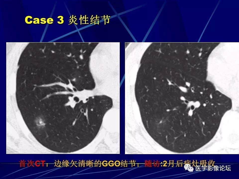 如何在肺内结节性病变中发现肺癌？