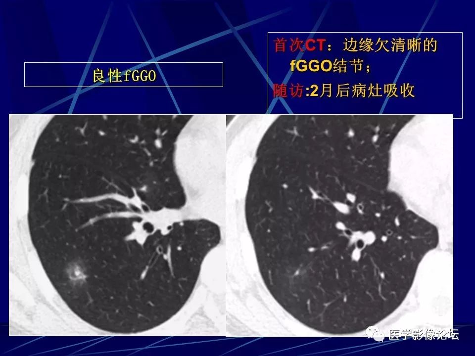 如何在肺内结节性病变中发现肺癌？