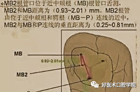 根管治疗中的疑难问题及解决方法，详细解析在这！