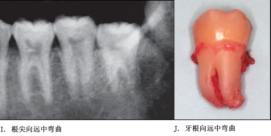 选择一种基于科学、微创、便捷的拔牙方式！口腔医生必看！