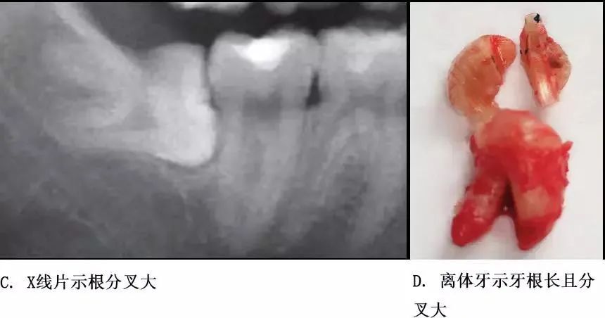 选择一种基于科学、微创、便捷的拔牙方式！口腔医生必看！