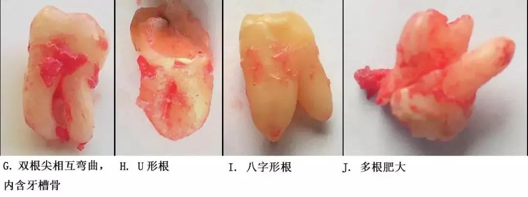 选择一种基于科学、微创、便捷的拔牙方式！口腔医生必看！