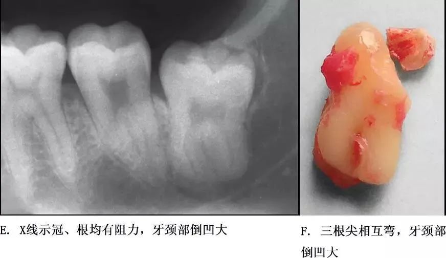 选择一种基于科学、微创、便捷的拔牙方式！口腔医生必看！