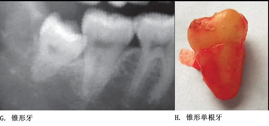 选择一种基于科学、微创、便捷的拔牙方式！口腔医生必看！