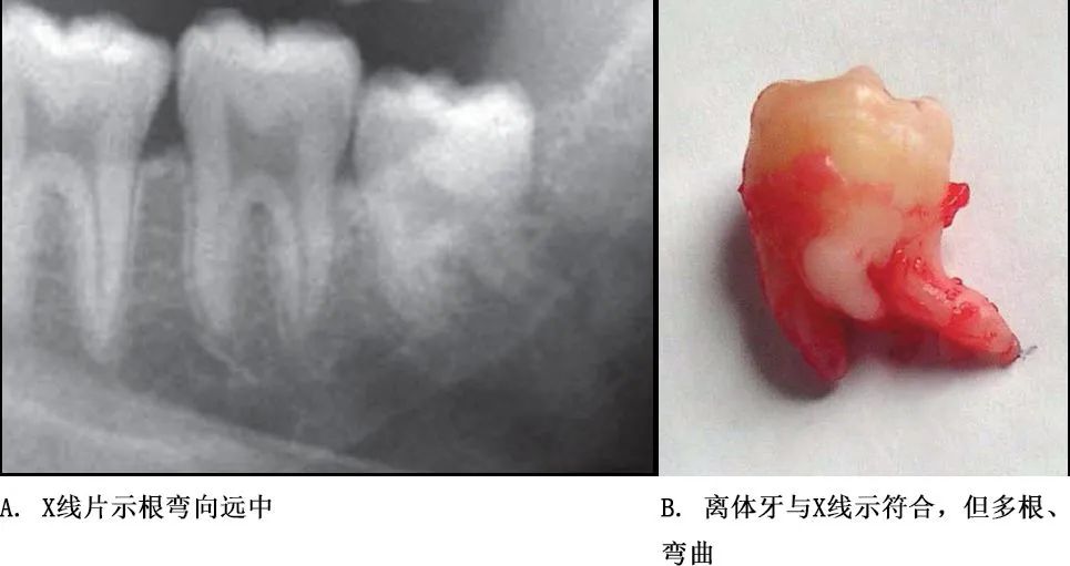 选择一种基于科学、微创、便捷的拔牙方式！口腔医生必看！