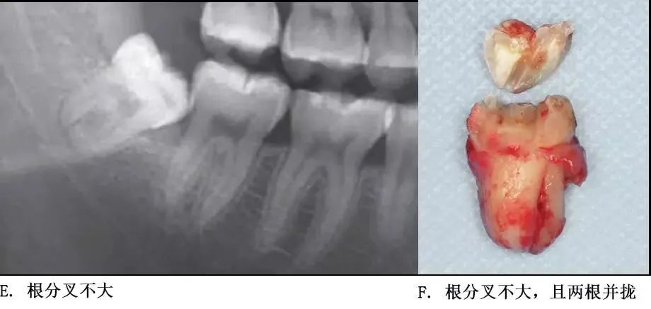 选择一种基于科学、微创、便捷的拔牙方式！口腔医生必看！