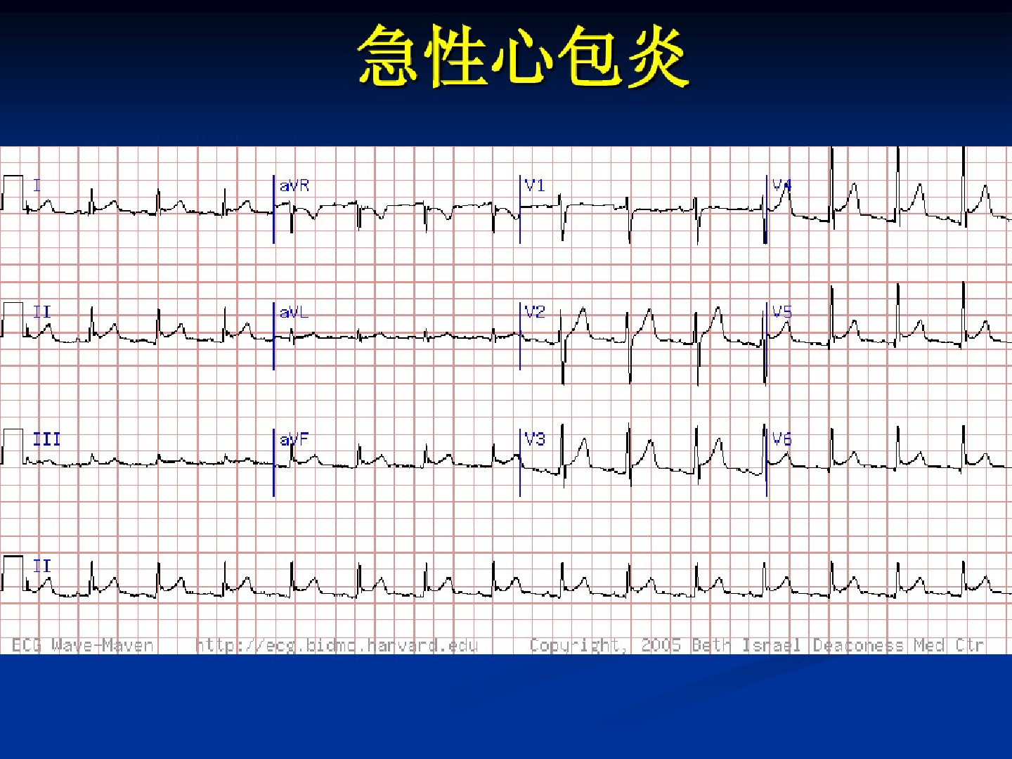 八大病例：教你看懂心肌缺血发作时的心电图表现（下）