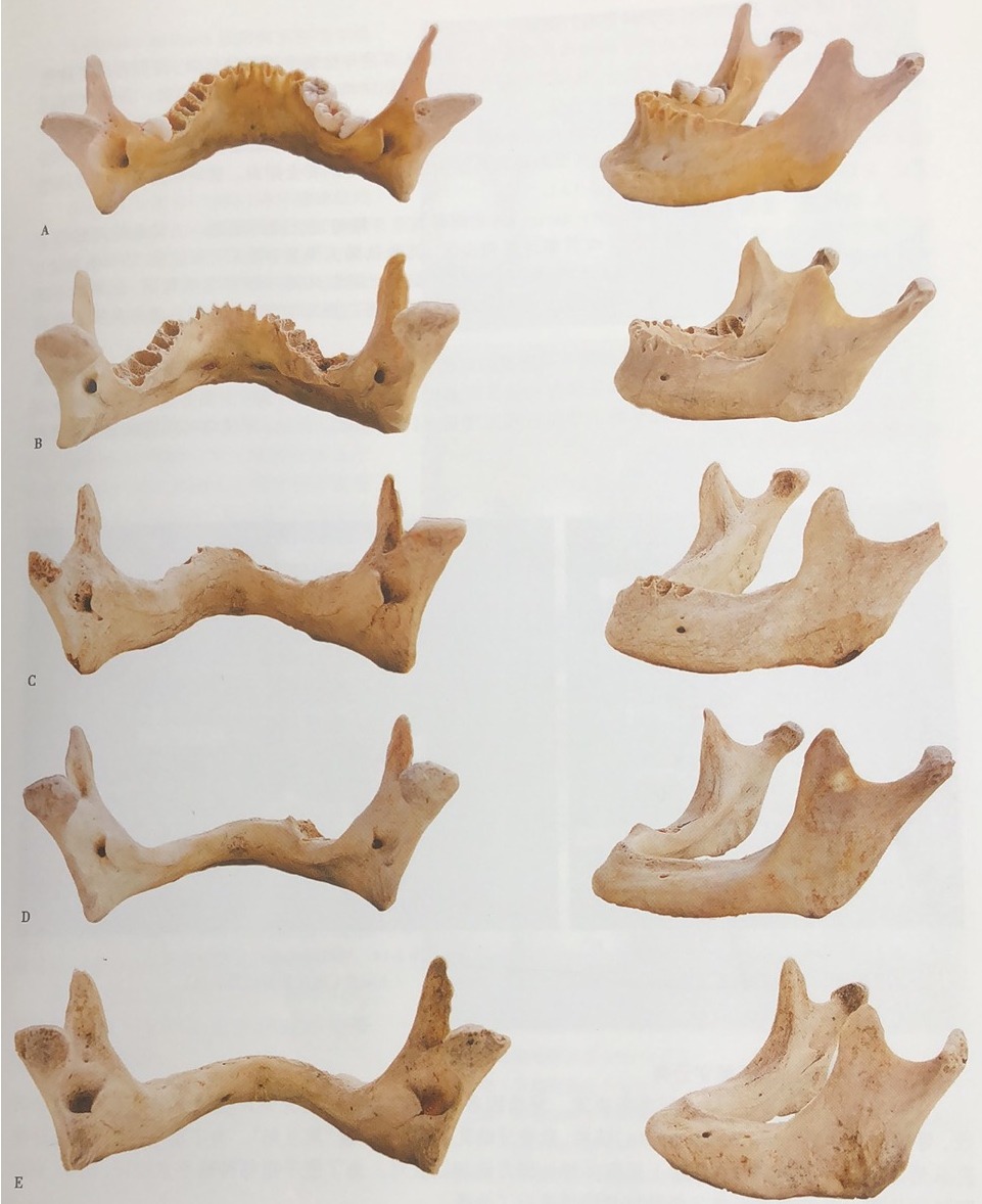 颌骨骨质和骨量在口腔种植中的应用，种植基础必备！