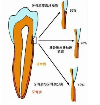 楔状缺损的原因图片