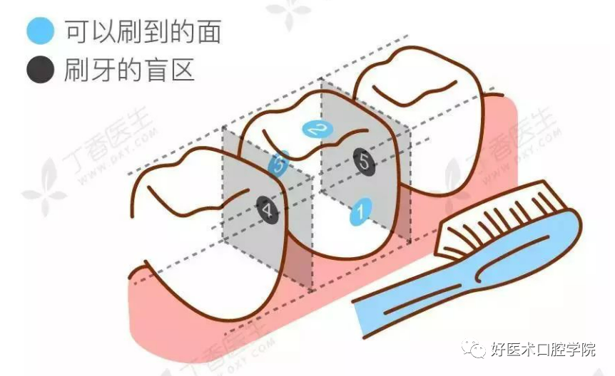 楔状缺损备洞形图解图片