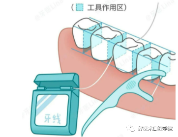 牙颈部非龋性病损(NCCL)——楔状缺损的树脂充填治疗，这几点必看！