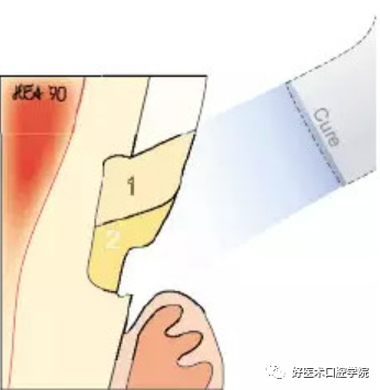 牙颈部非龋性病损(NCCL)——楔状缺损的树脂充填治疗，这几点必看！