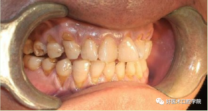 牙颈部非龋性病损(nccl)——楔状缺损的树脂充填治疗,这几点必看!