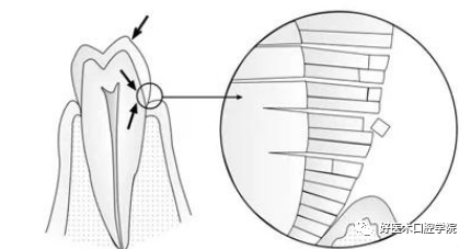 牙颈部非龋性病损(NCCL)——楔状缺损的树脂充填治疗，这几点必看！