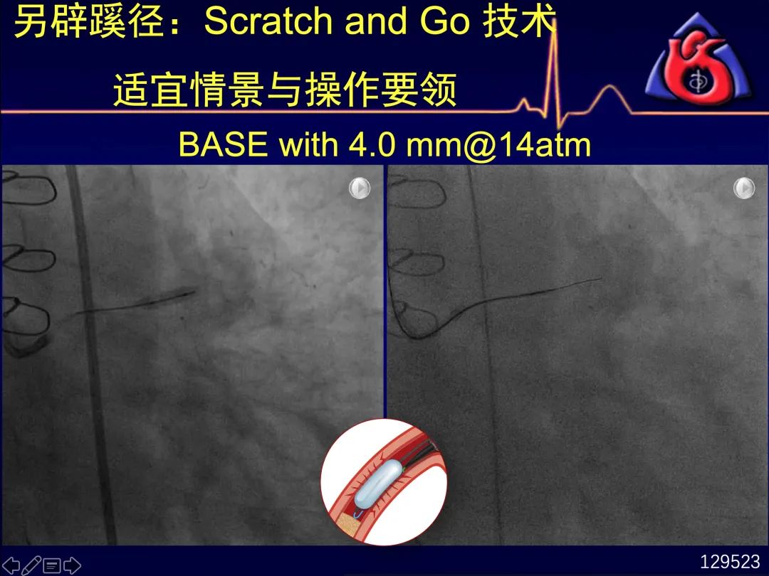 中国CTO病变介入治疗推荐路径更新！五大要点3分钟速读