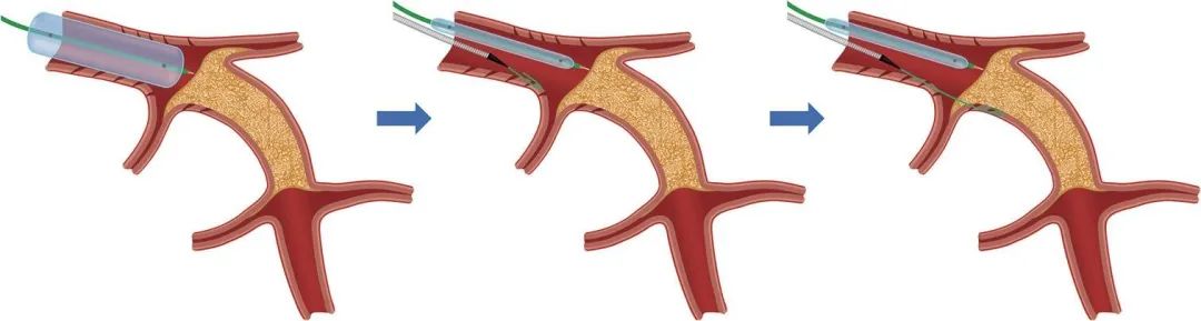 中国CTO病变介入治疗推荐路径更新！五大要点3分钟速读