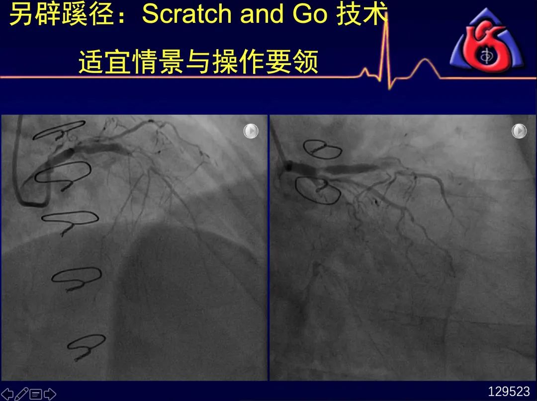 中国CTO病变介入治疗推荐路径更新！五大要点3分钟速读