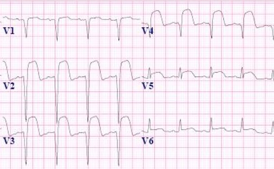 必知的5类心梗心电图，这些一定要掌握！