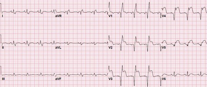 必知的5类心梗心电图，这些一定要掌握！