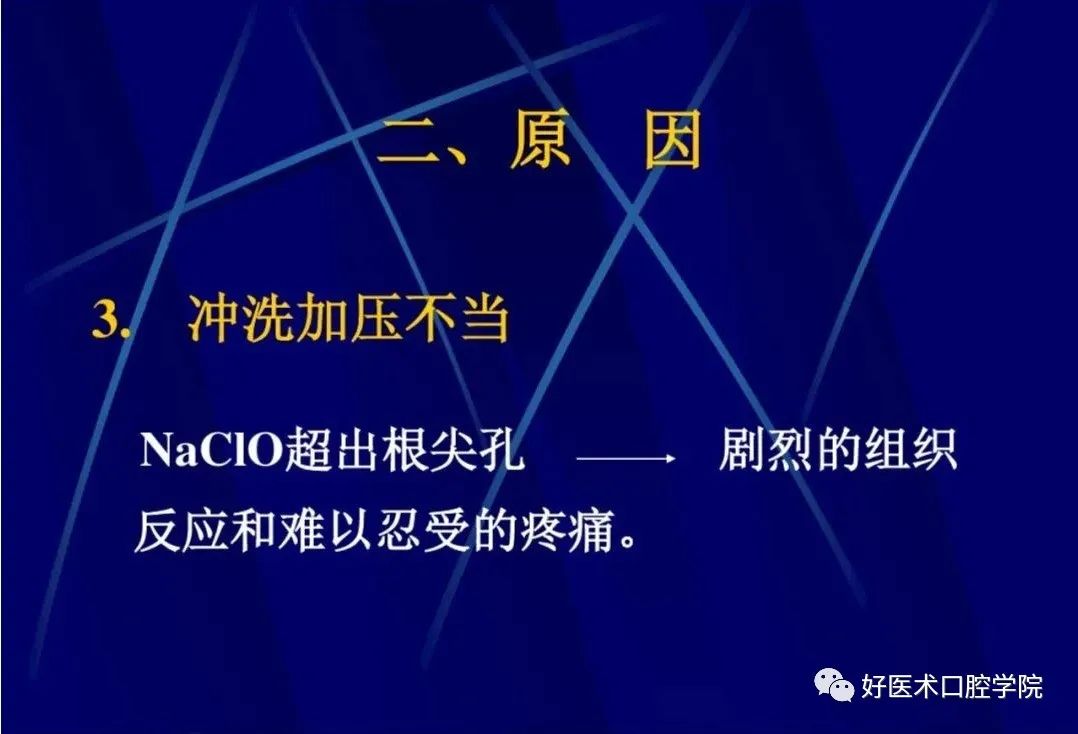 几张图明白根管治疗期间急性发作和急症处理，实用临床总结必看！