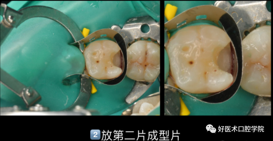 多结合面的龈壁提升靠谱吗？临床这样做更牢固！