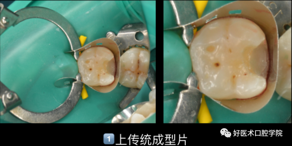 多结合面的龈壁提升靠谱吗？临床这样做更牢固！