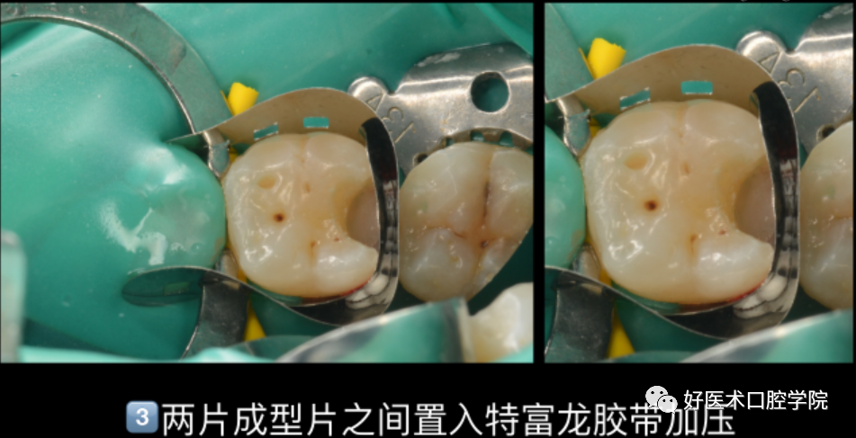 多结合面的龈壁提升靠谱吗？临床这样做更牢固！