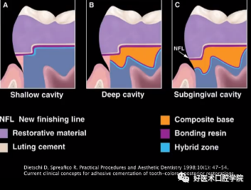 多结合面的龈壁提升靠谱吗？临床这样做更牢固！
