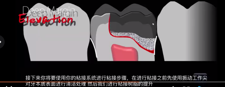 多结合面的龈壁提升靠谱吗？临床这样做更牢固！