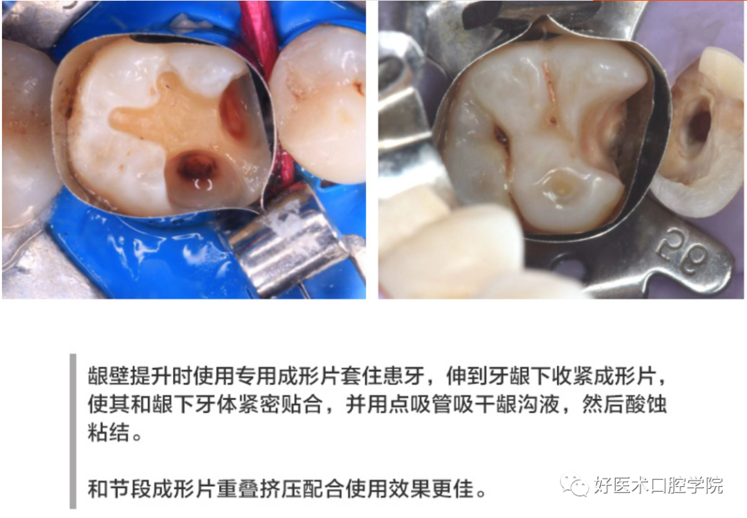 多结合面的龈壁提升靠谱吗？临床这样做更牢固！