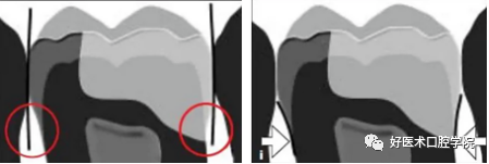 多结合面的龈壁提升靠谱吗？临床这样做更牢固！
