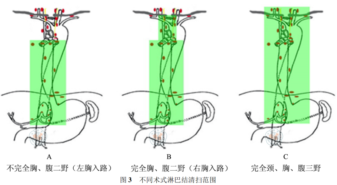 食管癌左胸入路和右胸入路有什么区别？放疗靶区勾哪里？