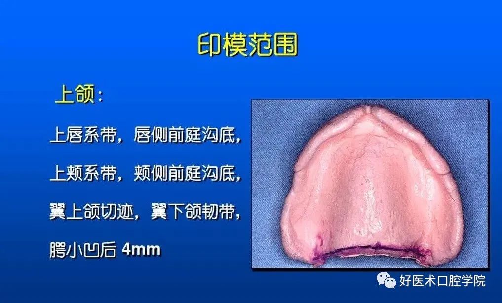 超清图解全口义齿印模制取方法，推荐收藏慢慢看！